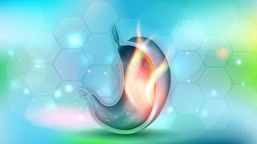 Στομαχική Παλινδρόμηση